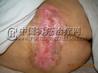 什么药物是专治褥疮的