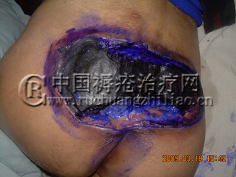 什么药物是专治褥疮的