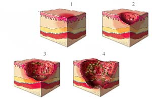 褥疮的分期处置方法