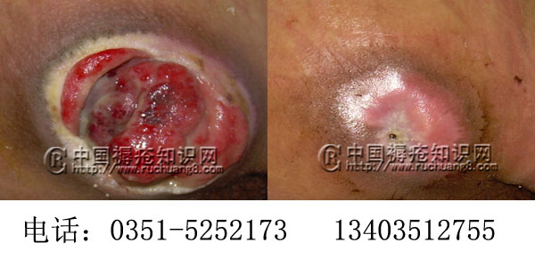 压疮治疗效果