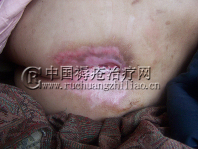 褥疮破了用什么药