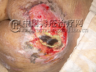 胯骨两侧褥疮用什么药好