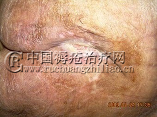 胯骨两侧褥疮用什么药好