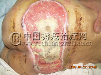 瘫痪老人得褥疮怎么治疗