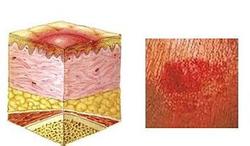 褥疮处于红斑期怎样护理最有效