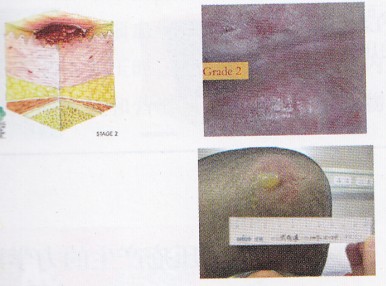 二期褥疮的症状