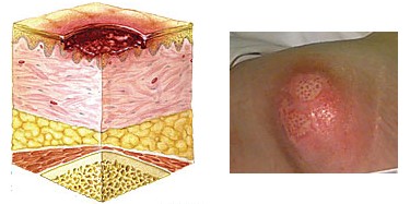 褥疮的II期症状