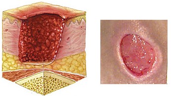 褥疮III期症状