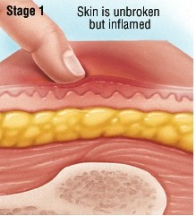 褥疮的一期症状