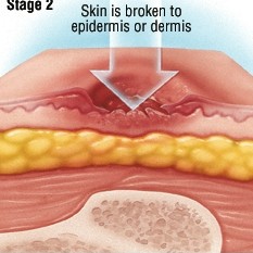 褥疮的二期症状