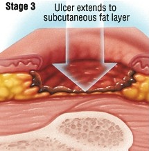 褥疮的三期症状
