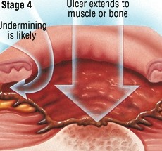 褥疮的四期症状