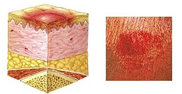 褥疮初期怎么办