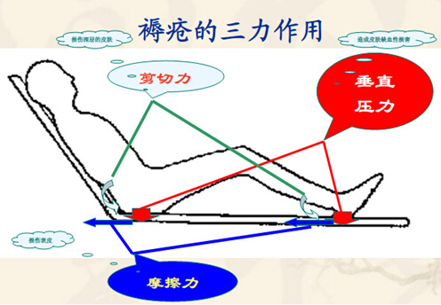 引发褥疮的剪切力与摩擦力有哪些区别