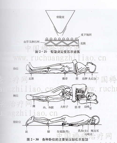 褥疮的好发部位及分级