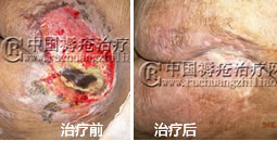 深度褥疮出现坏死组织怎么办
