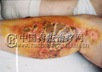 烫伤的病例